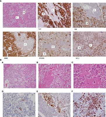 Mixed corticomedullary tumor of the adrenal gland